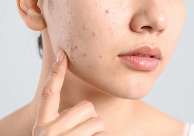 Closeup up of a woman's cheek with acne.
