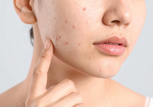 Closeup up of a woman's cheek with acne.